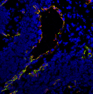 cerebral cavernomas